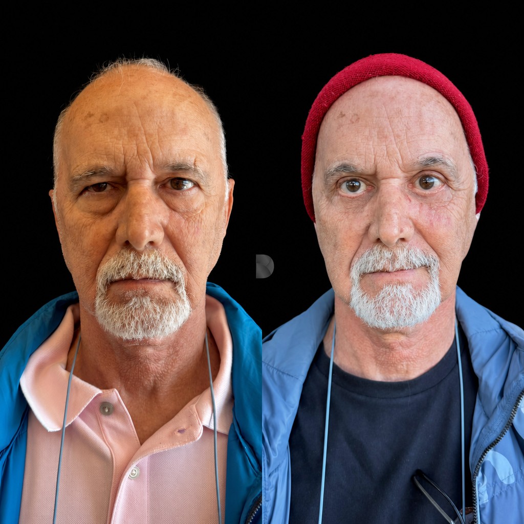 Antes e depois de blefaroplastia com o Dr. Claudio Farcic