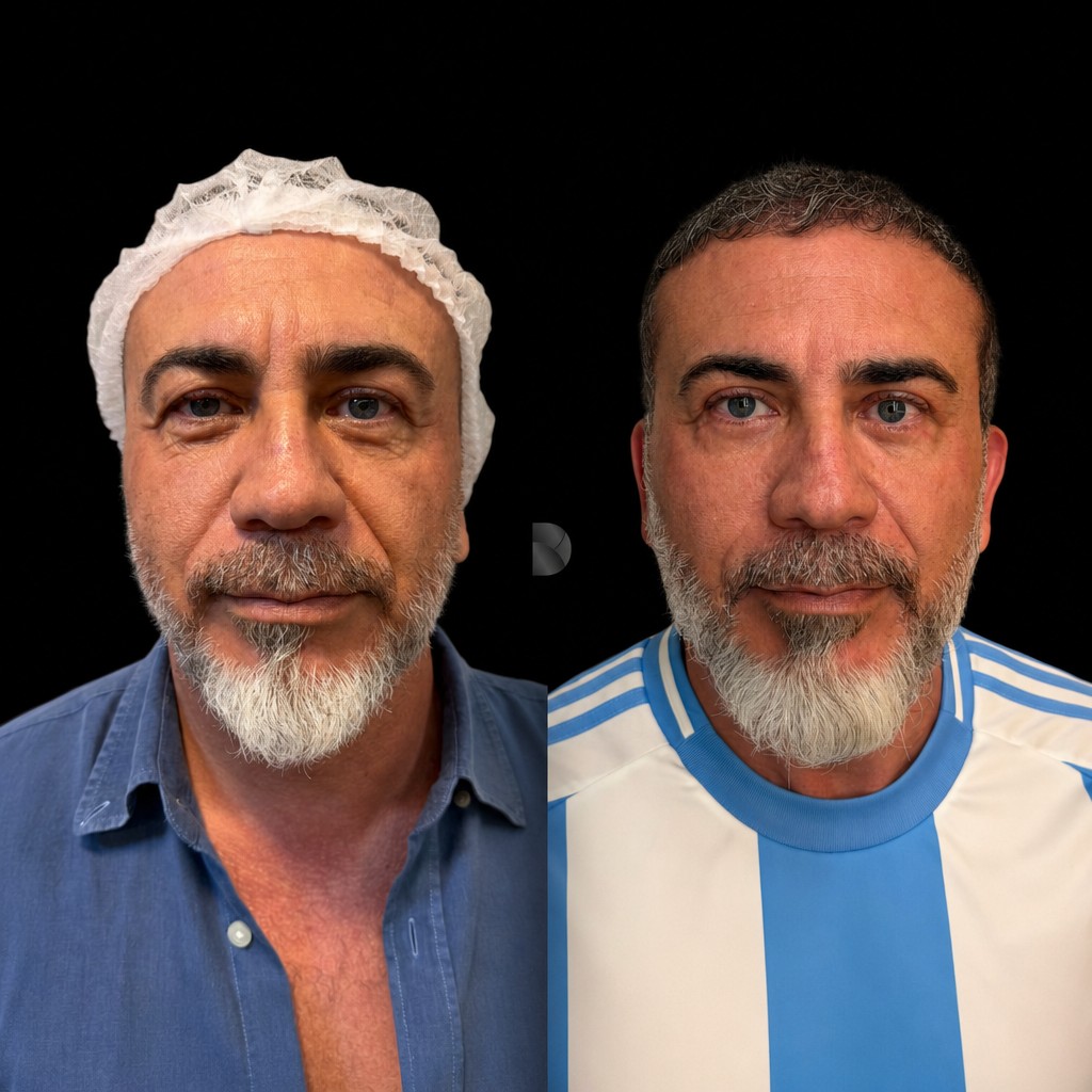 Antes e depois de blefaroplastia com o Dr. Claudio Farcic